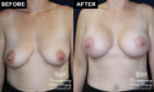 breast augmentation results at Contemporary Plastic Surgery