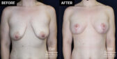 Mastopexy and breast implant results at Contemporary Plastic Surgery