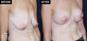 breast augmentation with mastopexy before and after results