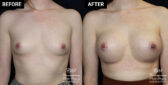 Breast augmentation patient results at Contemporary Plastic Surgery