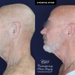 patient 18982 neck lift results at Contemporary Plastic Surgery