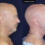patient 18982 neck lift results at Contemporary Plastic Surgery