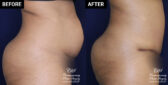 abdominoplasty tummy tuck patient results at Contemporary Plastic Surgery