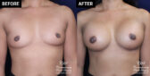breast augmentation patient results at Contemporary Plastic Surgery