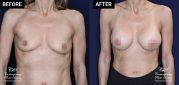 breast augmentation patient results at Contemporary Plastic Surgery