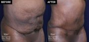 tummy tuck and liposuction patient results at Contemporary Plastic Surgery