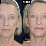 face and neck lift before and after results at Contemporary Plastic Surgery