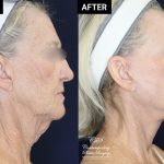 face and neck lift before and after results at Contemporary Plastic Surgery