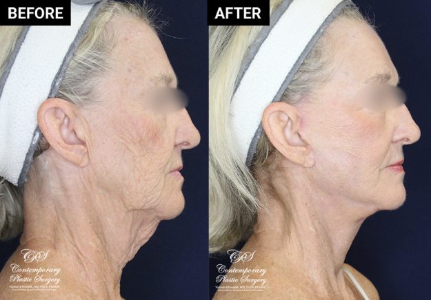 face and neck lift before and after results at Contemporary Plastic Surgery