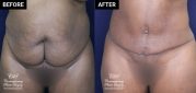 tummy tuck and liposuction patient before and after results at Contemporary Plastic Surgery