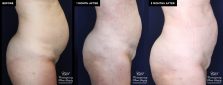 Enhanced contouring before and after results with liposuction and Renuvion®