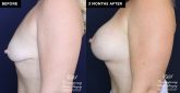 breast implants before and after results at Contemporary Plastic Surgery