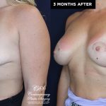 breast implants before and after results at Contemporary Plastic Surgery