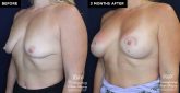breast implants before and after results at Contemporary Plastic Surgery