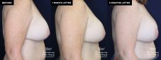 breast implant replacement at Contemporary Plastic Surgery
