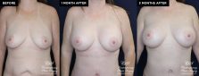 breast augmentation patient 19593 before and after results at Contemporary Plastic Surgery