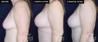breast augmentation patient 19593 before and after results at Contemporary Plastic Surgery