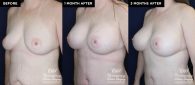 breast augmentation patient 19593 before and after results at Contemporary Plastic Surgery