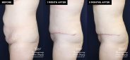 tummy tuck and liposuction patient results at Contemporary Plastic Surgery