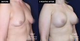 breast implant patient 19597 before and after results at Contemporary Plastic Surgery
