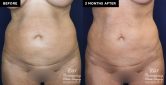 patient 19639 before and after subdermal Renuvion results at Contemporary Plastic Surgery