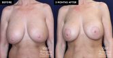 patient 19639 breast implant removal and replacement before and after results at Contemporary Plastic Surgery