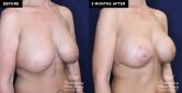 patient 19639 breast implant removal and replacement before and after results at Contemporary Plastic Surgery