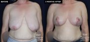 breast augmentation before and after results at Contemporary Plastic Surgery