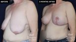 breast augmentation before and after results at Contemporary Plastic Surgery