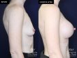 patient 19922 breast augmentation results at Contemporary Plastic Surgery