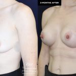 patient 19922 breast augmentation results at Contemporary Plastic Surgery