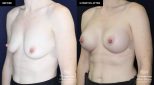 patient 19922 breast augmentation results at Contemporary Plastic Surgery