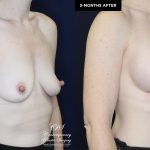 patient 19922 breast augmentation results at Contemporary Plastic Surgery