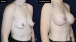 patient 19922 breast augmentation results at Contemporary Plastic Surgery