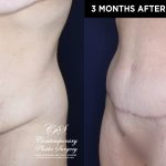 Patient 20030 abdominoplasty before and after results at Contemporary Plastic Surgery