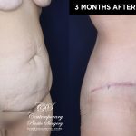 Patient 20030 abdominoplasty before and after results at Contemporary Plastic Surgery