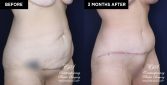 Patient 20030 abdominoplasty before and after results at Contemporary Plastic Surgery