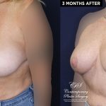 Patient 20036's breast reduction before and after results at Contemporary Plastic Surgery