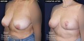 Patient 20036's breast reduction before and after results at Contemporary Plastic Surgery