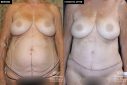 patient 20038 tummy tuck and liposuction before and after results at Contemporary Plastic Surgery