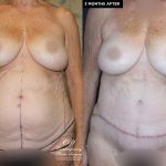 patient 20038 tummy tuck and liposuction before and after results at Contemporary Plastic Surgery