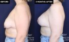 Patient 20074 breast lift with augmentation at Contemporary Plastic Surgery