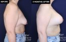 Patient 20074 breast lift with augmentation at Contemporary Plastic Surgery