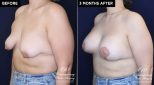 Patient 20074 breast lift with augmentation at Contemporary Plastic Surgery