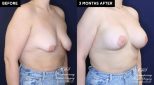 Patient 20074 breast lift with augmentation at Contemporary Plastic Surgery