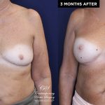 Patient 20076's breast implant before and after results at Contemporary Plastic Surgery