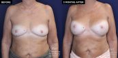Patient 20076's breast implant before and after results at Contemporary Plastic Surgery