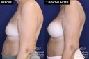 Patient 20076's breast implant before and after results at Contemporary Plastic Surgery