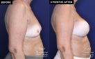 Patient 20076's breast implant before and after results at Contemporary Plastic Surgery