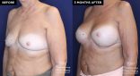 Patient 20076's breast implant before and after results at Contemporary Plastic Surgery